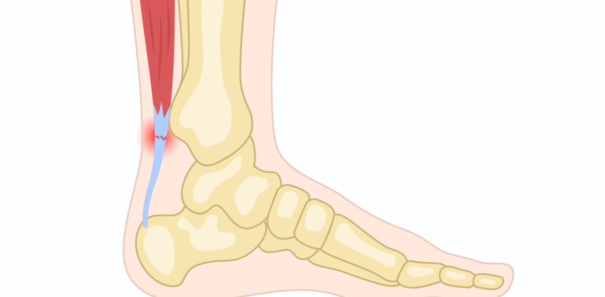 Graphic showing achilles tendonitis
