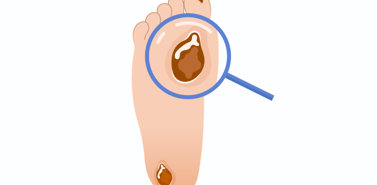 Graphic of foot and ankle ulcer