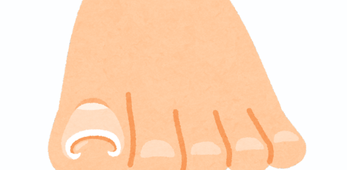 Graphic of ingrown toenail