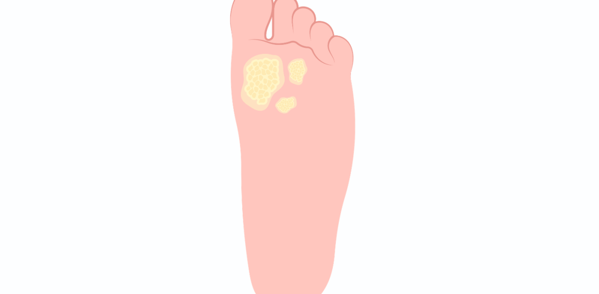 Graphic foot with a wart